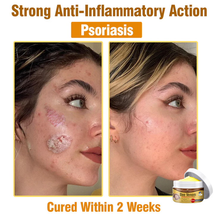 👩 flysmus™ Bee Venom Comprehensive Cream 🇦🇺 Dermatologist Approved