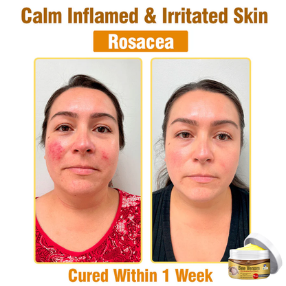 👩 flysmus™ Bee Venom Comprehensive Cream 🇦🇺 Dermatologist Approved
