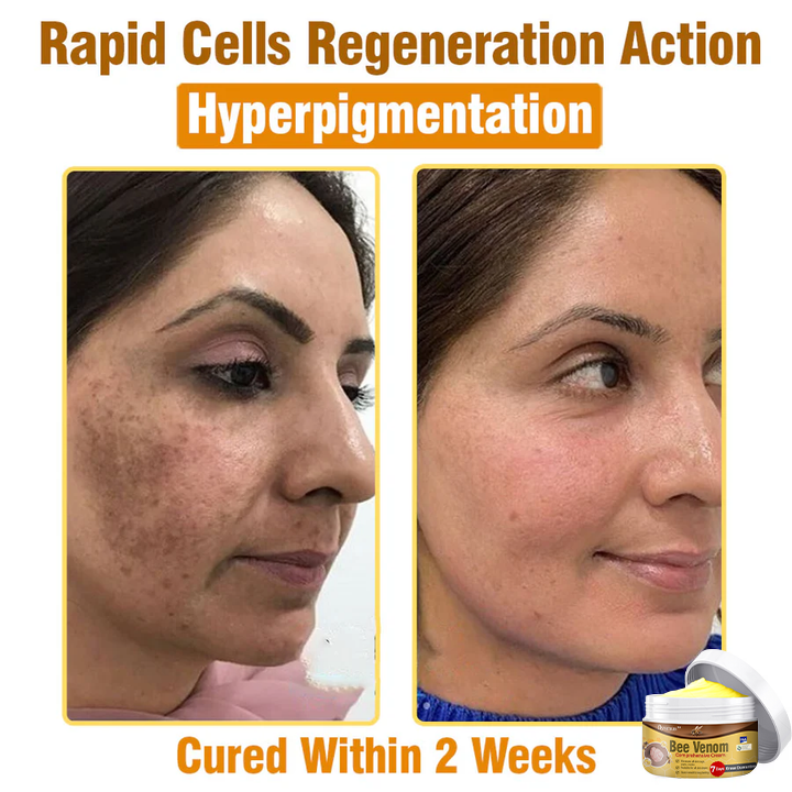 👩 flysmus™ Bee Venom Comprehensive Cream 🇦🇺 Dermatologist Approved