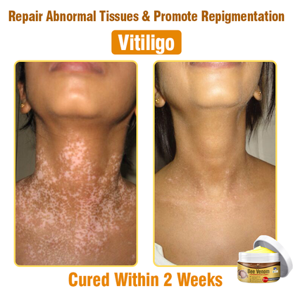 👩 flysmus™ Bee Venom Comprehensive Cream 🇦🇺 Dermatologist Approved