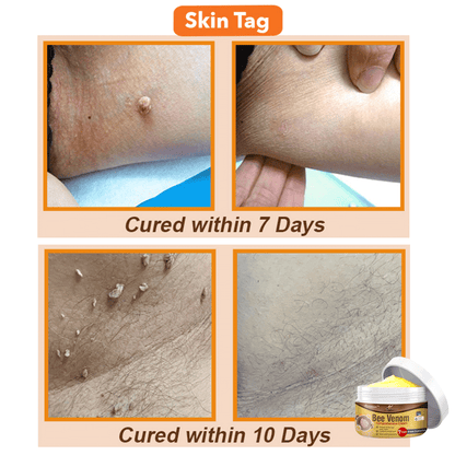 🐝 flysmus™ Bee Venom Comprehensive Cream 🇦🇺👨‍🔬 Dermatologist Approved