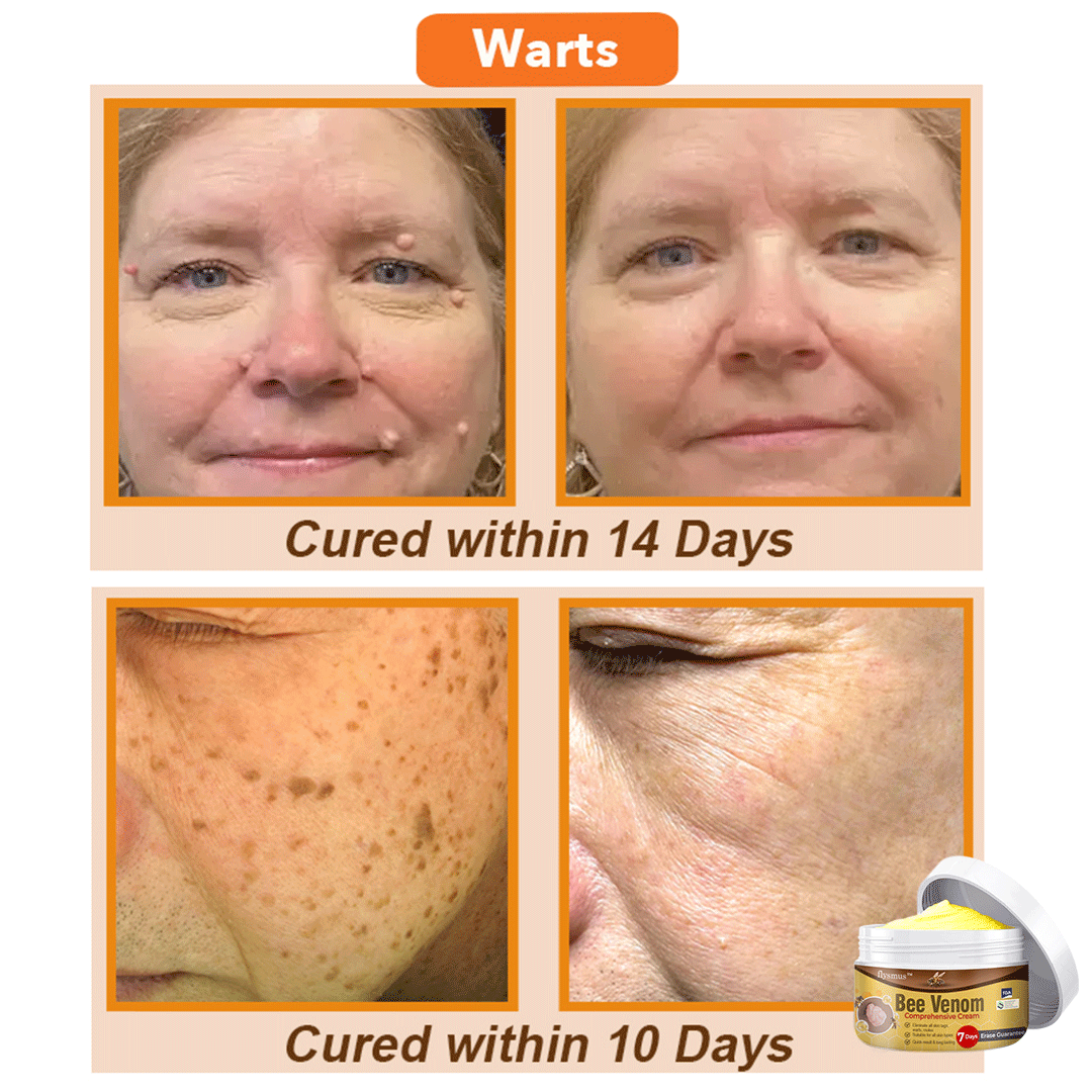 💞 flysmus™ Bee Venom Comprehensive Skin Treatment Cream 🇦🇺 Dermatologist Recommended ✅
