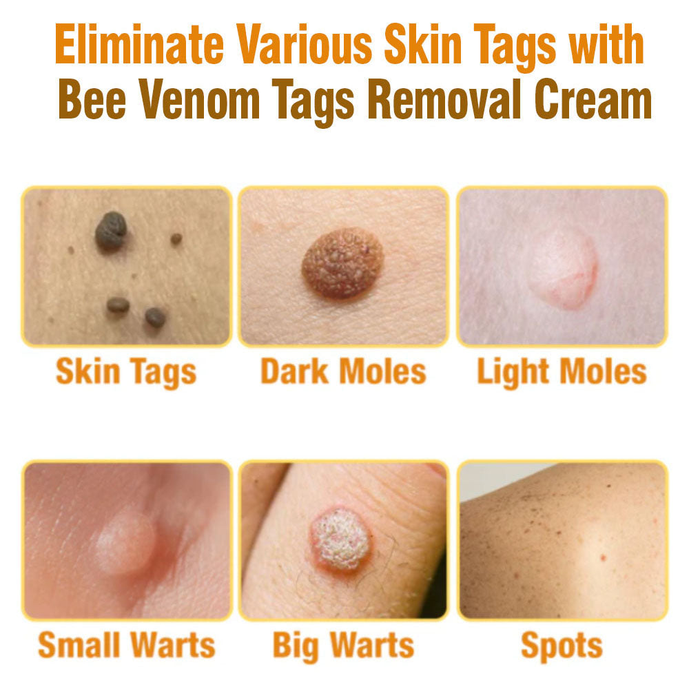 flysmus™ Bee Venom Tags Removal Cream 🇦🇺