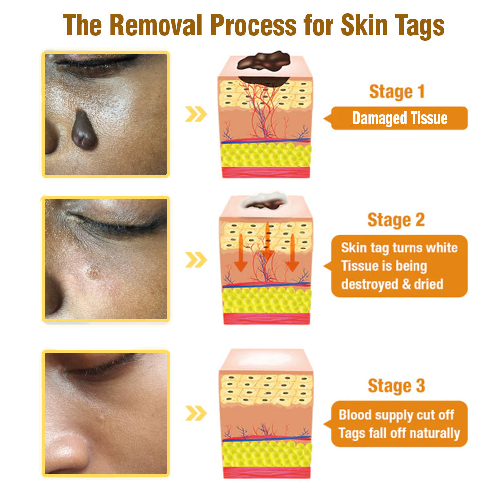 flysmus™ Bee Venom Tags Removal Cream 🇦🇺