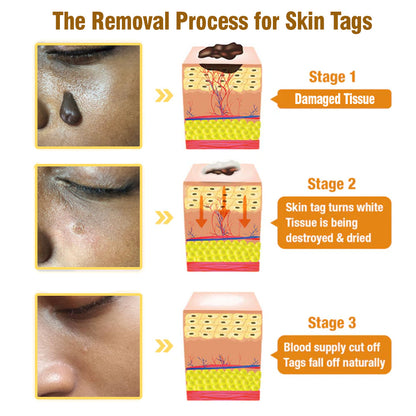 flysmus™ Bee Venom Tags Removal Cream 🇦🇺